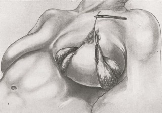 Early illustration of mamma-plasty by Jacques Joseph.<br /> <br /> <em>J. Joseph, Nasenplastik und sonstige Gesichtsplastik, Leipzig 1931</em>