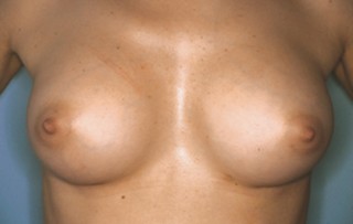 This patient wanted the contours of her almost boyish body to be rounded - silicone implants have made it possible. (c) Private archive Dr. de Benito