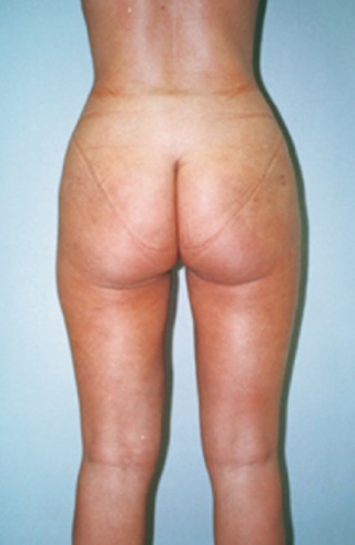 <span class="td">... and after her buttocks and upper thighs were operated on. (c) Private archive Dr. de Benito</span>