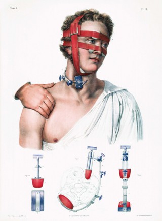 Compression of the arteries of head and neck